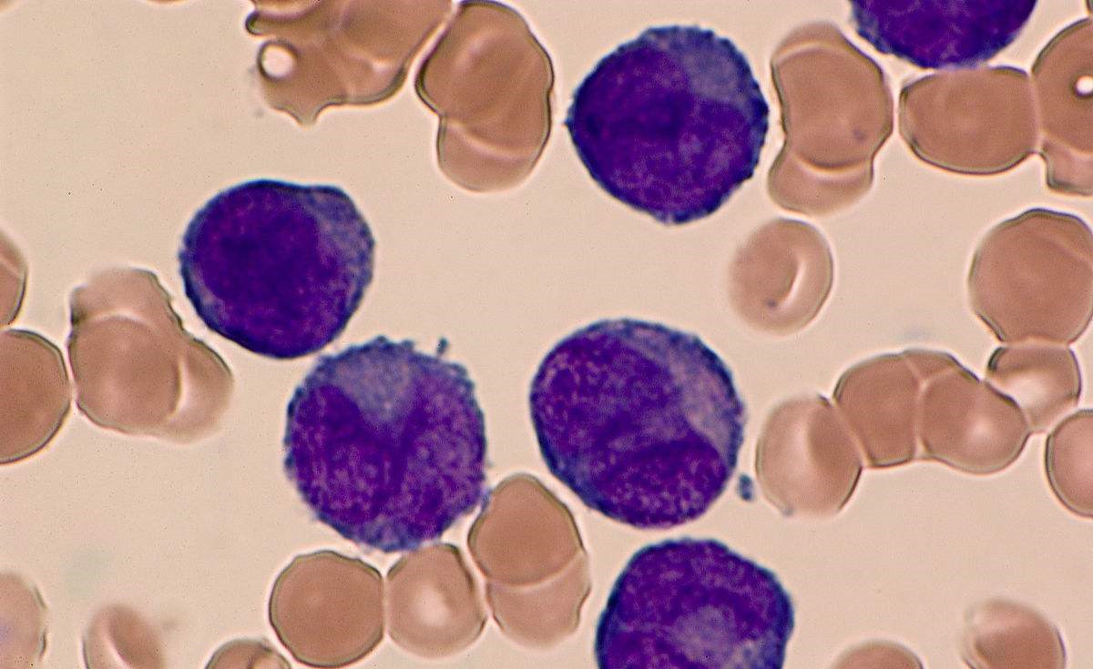 家庭裝修是導(dǎo)致白血病的***因素！家里甲醛超標(biāo)怎么辦